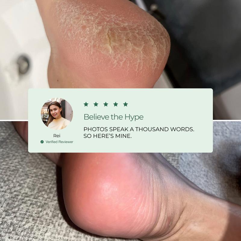 Sandal Season? Your Feet Are Ready NOW: Foot Peel Mask